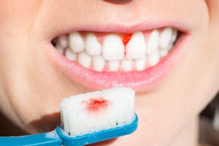 مسواک زدن یا نخ‌دندان کشیدن خیلی محکم هم ممکن است باعث ایجاد خون‌ریزی لثه شود.